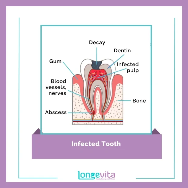 Root Canal Procedure 1