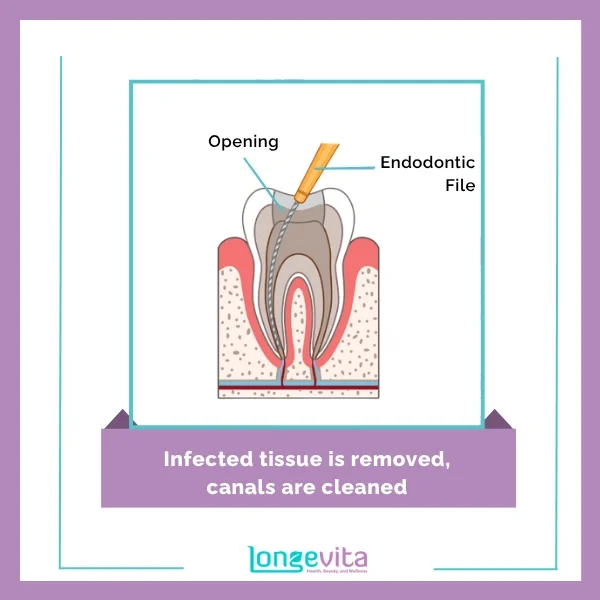 Root Canal Procedure 2