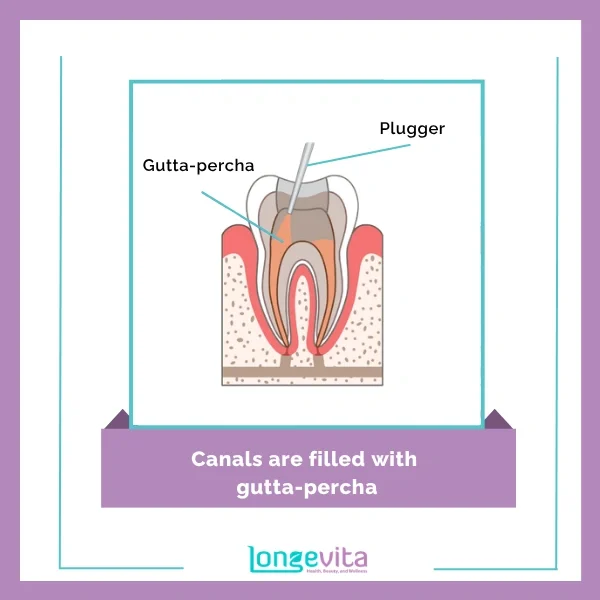 Root Canal Procedure 3