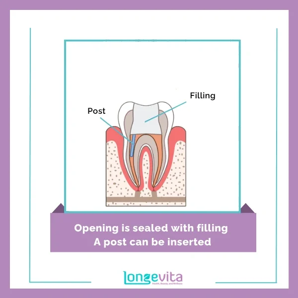 Root Canal Procedure 4
