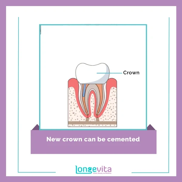 Root Canal Procedure 5