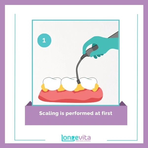 Scale polish procedure step 1