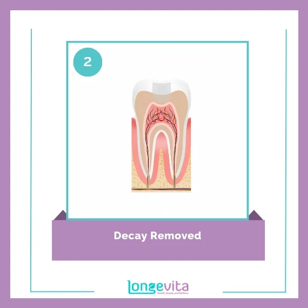 Tooth filling procedure 2