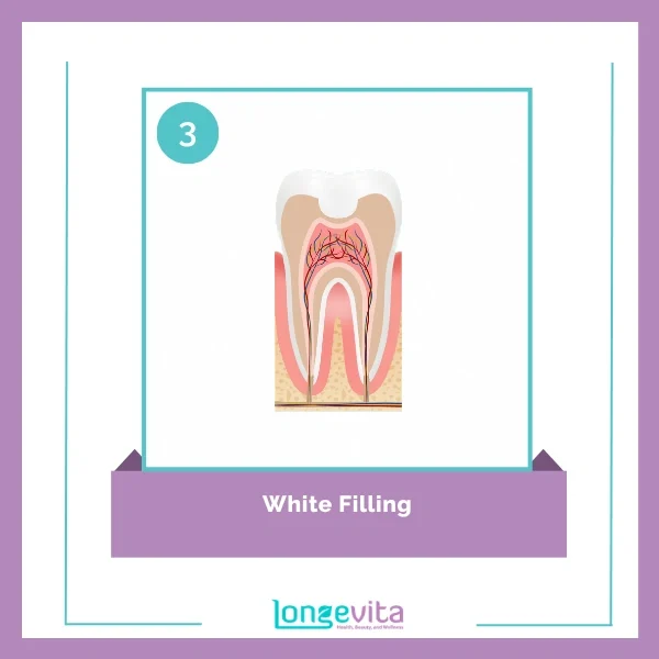 Tooth filling procedure 3