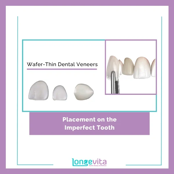 Veneers process 1
