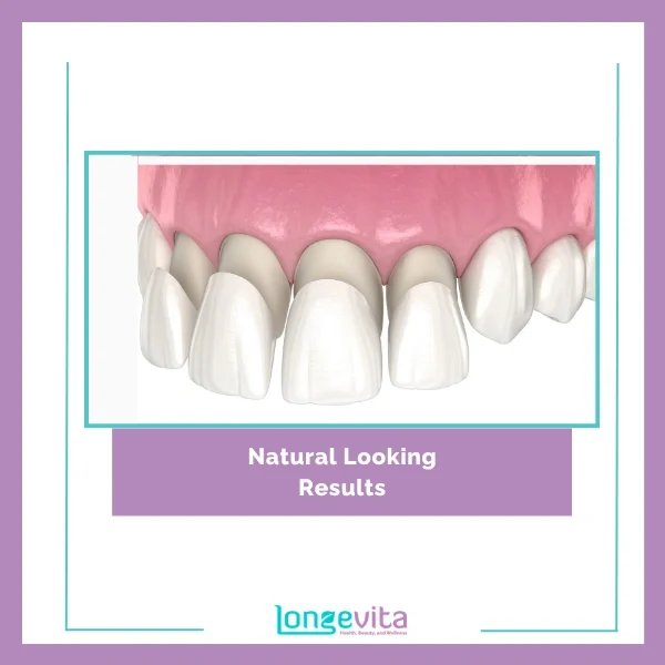 Veneers process 2