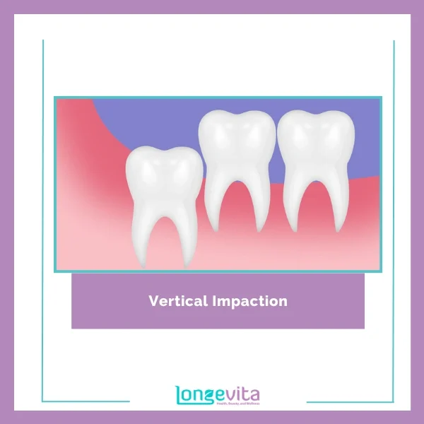 Vertical Impaction Extraction