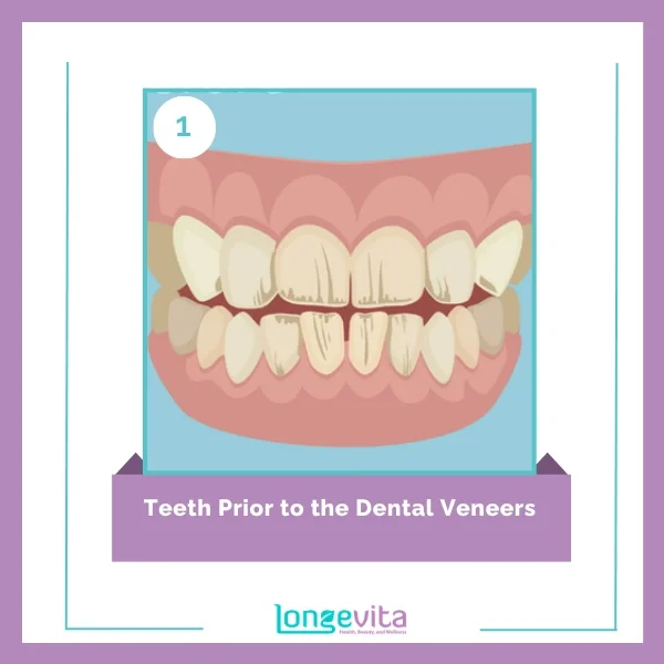 veneer procedure step 1
