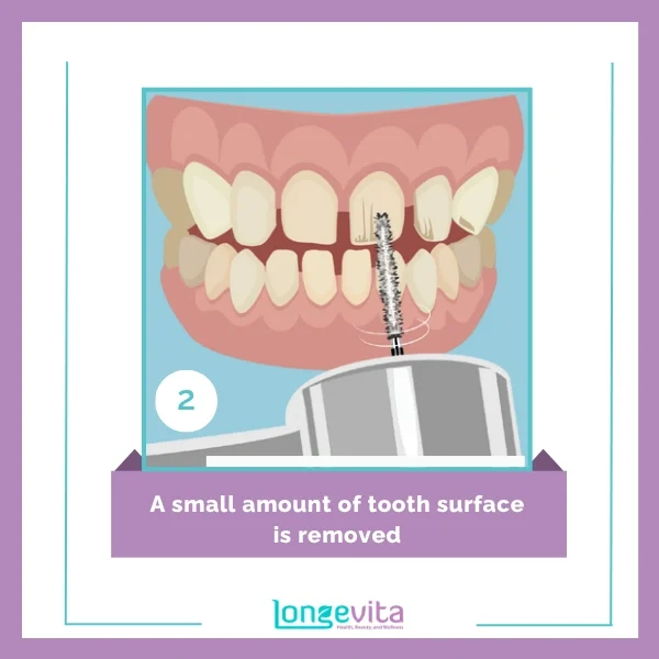 veneer procedure step 2