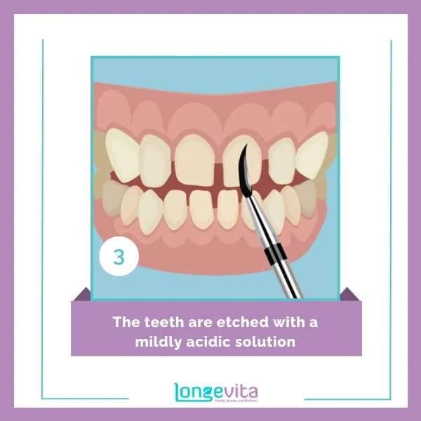veneer procedure step 3