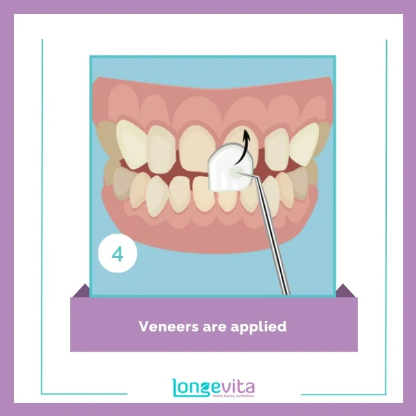 veneer procedure step 4