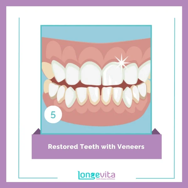 veneer procedure step 5